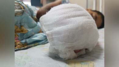 Niño sufre amputación de cuatro dedos de su mano tras jugar con pólvora