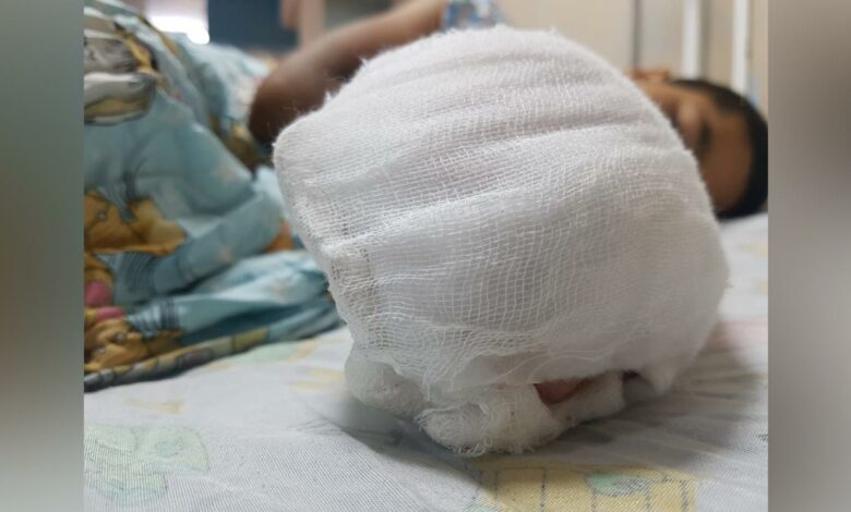Niño sufre amputación de cuatro dedos de su mano tras jugar con pólvora