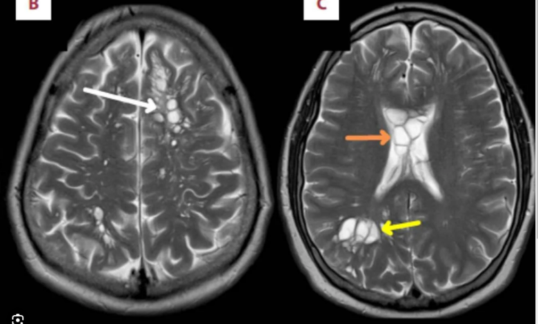 Hombre acude al hospital por migraña; le encuentran larvas en el cerebro tras comer tocino